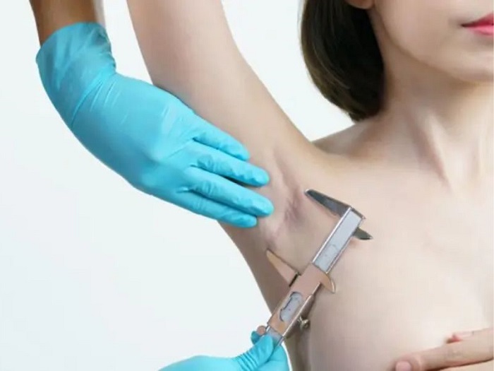 Clip nâng ngực qua đường nách