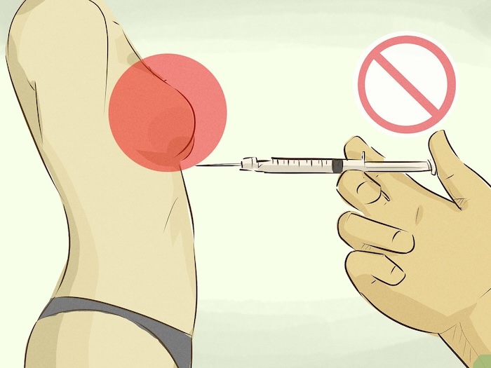 Giá nâng ngực bằng filler Giá nâng ngực bằng filler