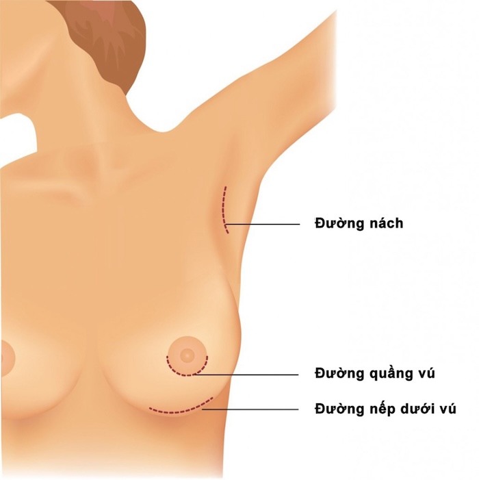 Nâng ngực có thể cho con bú không