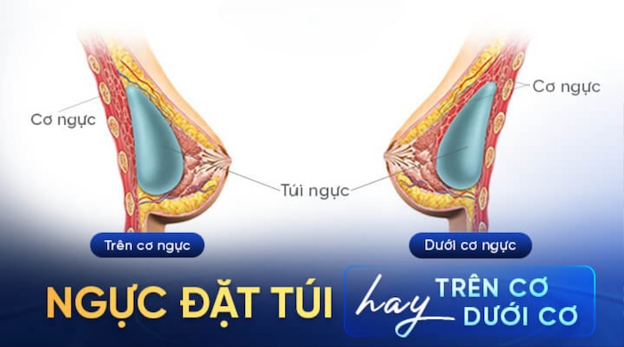 Nâng ngực trên cơ và dưới cơ