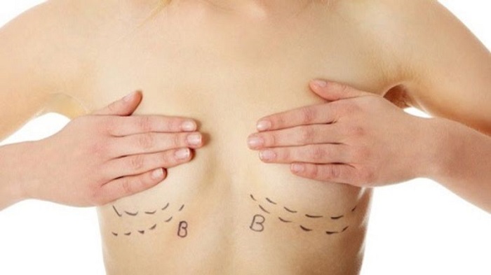 Phẫu thuật cắt bỏ ngực tại việt nam