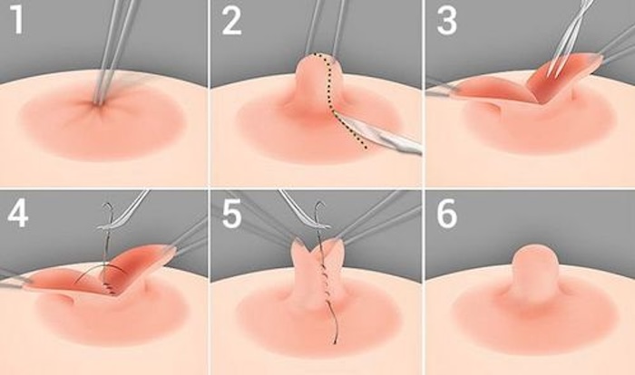 Phẫu thuật đầu ngực Phẫu thuật đầu ngực