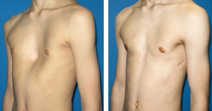 Phẫu thuật lõm ngực bẩm sinh Phẫu thuật lõm ngực bẩm sinh