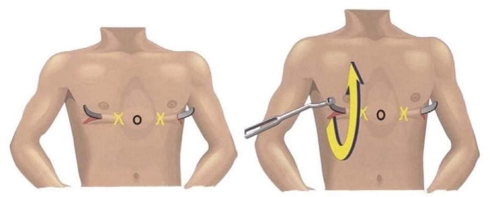 Phẫu thuật lõm ngực ở đâu Phẫu thuật lõm ngực ở đâu