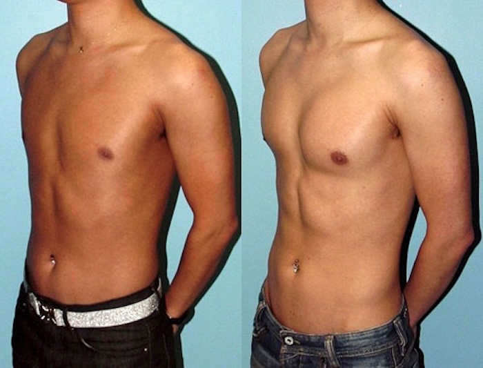 Phẫu thuật ngực đàn ông