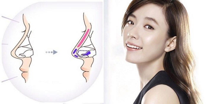 Nâng Mũi Cấu Trúc