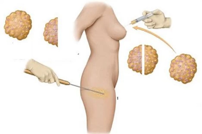 Nâng Ngực Bằng Mỡ Tự Thân